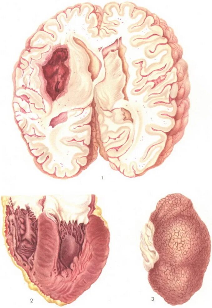 Гипертрофия сердца макропрепарат. Обширное кровоизлияние. Гипертрофия головного мозга.