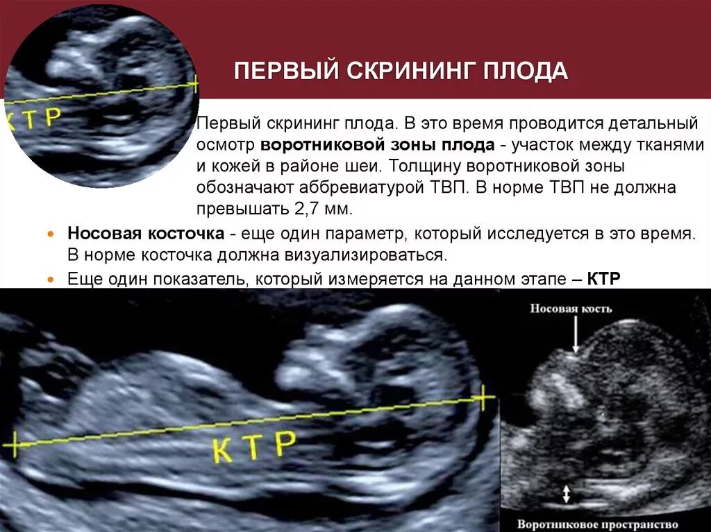 На каких сроках делается. Первый скрининг. Первый скрининг беременности. Плод на 1 скрининге.