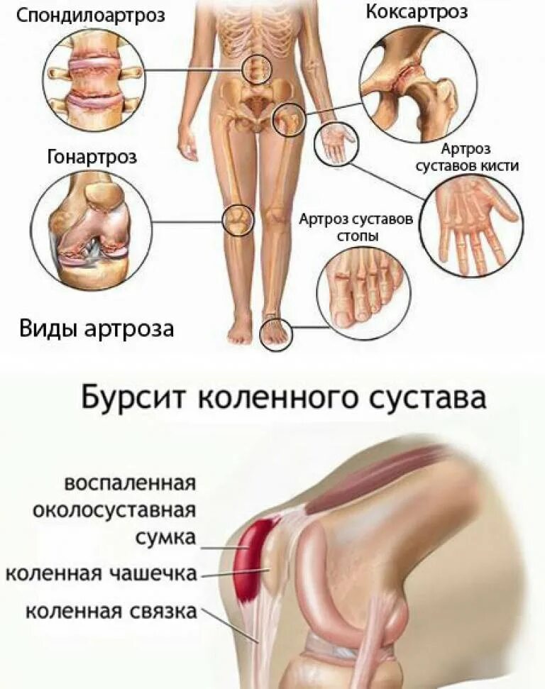 Почему заболели суставы. Суставы. Болят суставы. Заболевание крупных суставов.