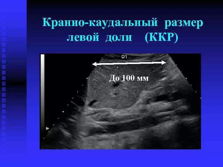 4 размера печени. Измерение печени на УЗИ. Толщина левой доли печени на УЗИ. Измерение размеров печени на УЗИ. Краниокаудальный размер левой доли печени.