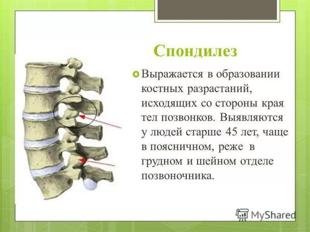 Спондилез поясничного отдела позвонков 1 степени. Спондилез и остеохондроз поясничного отдела позвоночника. Спондилез 2 степени поясничного отдела позвоночника. Спондилёз поясничного отдела позвоночника остеофиты. Картина спондилеза