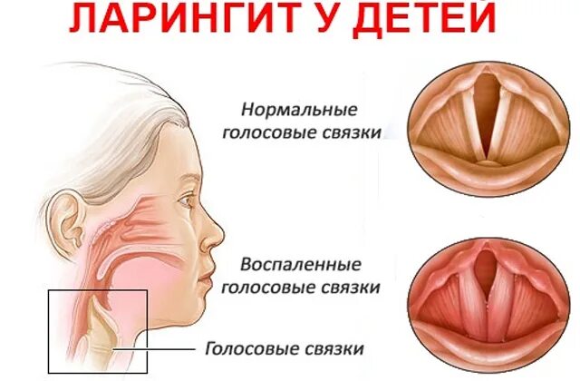 Острый ларингит у детей симптомы. Голосовые связки ларингит. Ларингит симптомы у детей симптомы. Хронический катаральный ларингит.