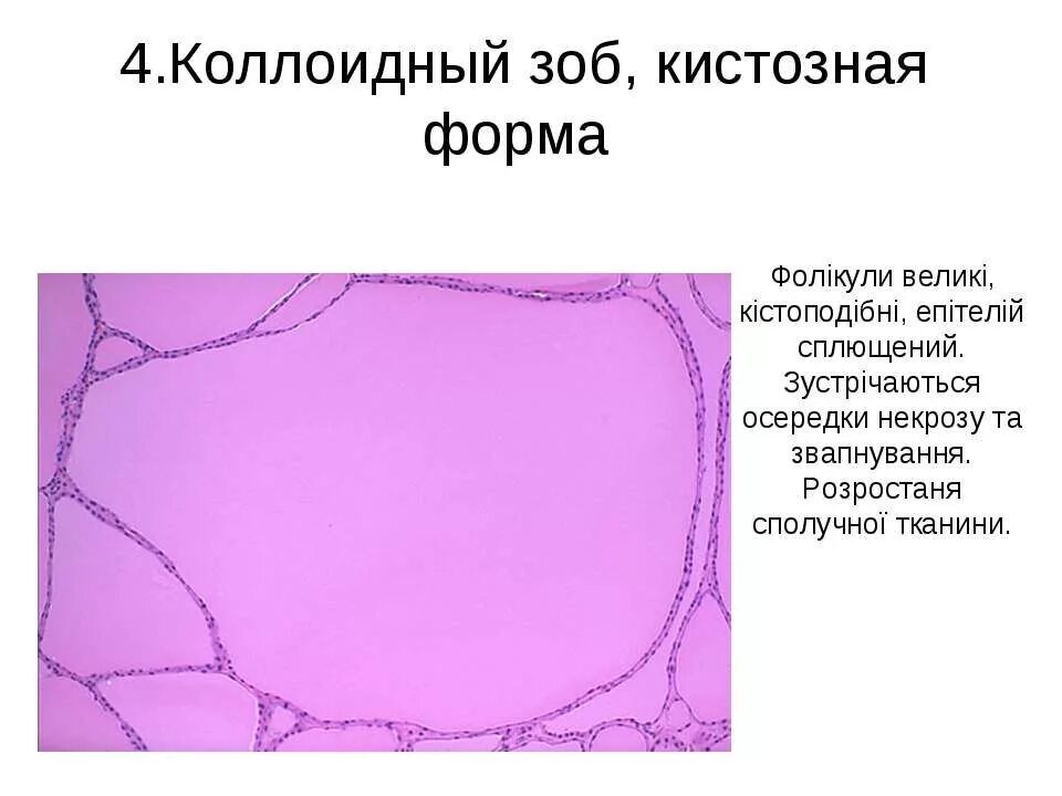 Коллоидный зоб. Коллоидный зоб