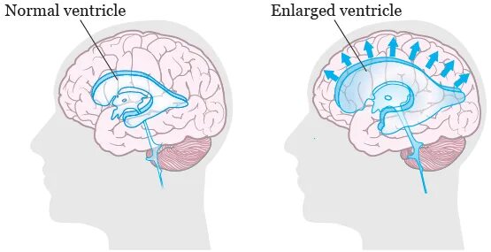 Гидроцефалия шунтирование мозга. Шунт головного мозга при гидроцефалии. Вентрикулоперитонеальный шунт.