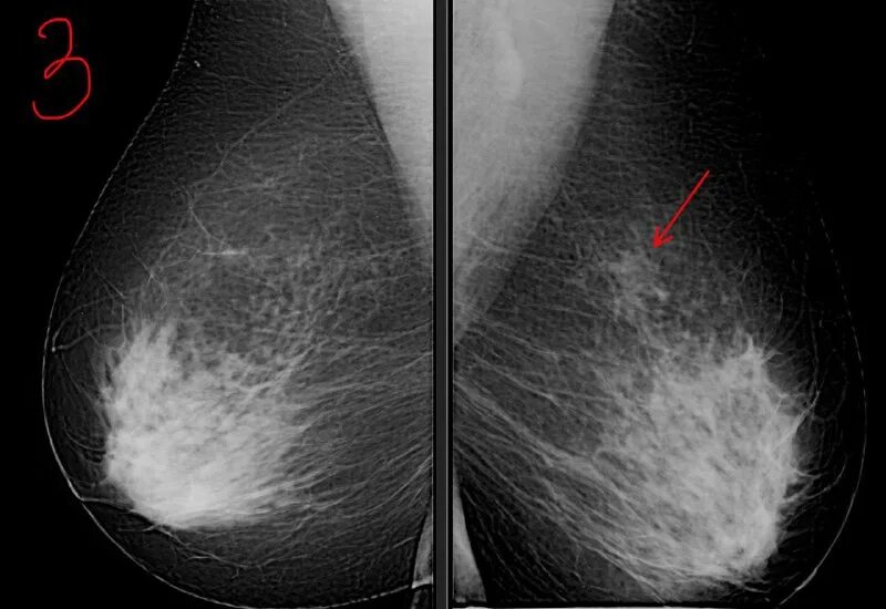 Ii тип плотности ткани молочной железы. изопреноиды. очаговая асимметрия левой молочной. очаговая асимметрия молочной железы рентген. диффузный фиброаденоматоз.