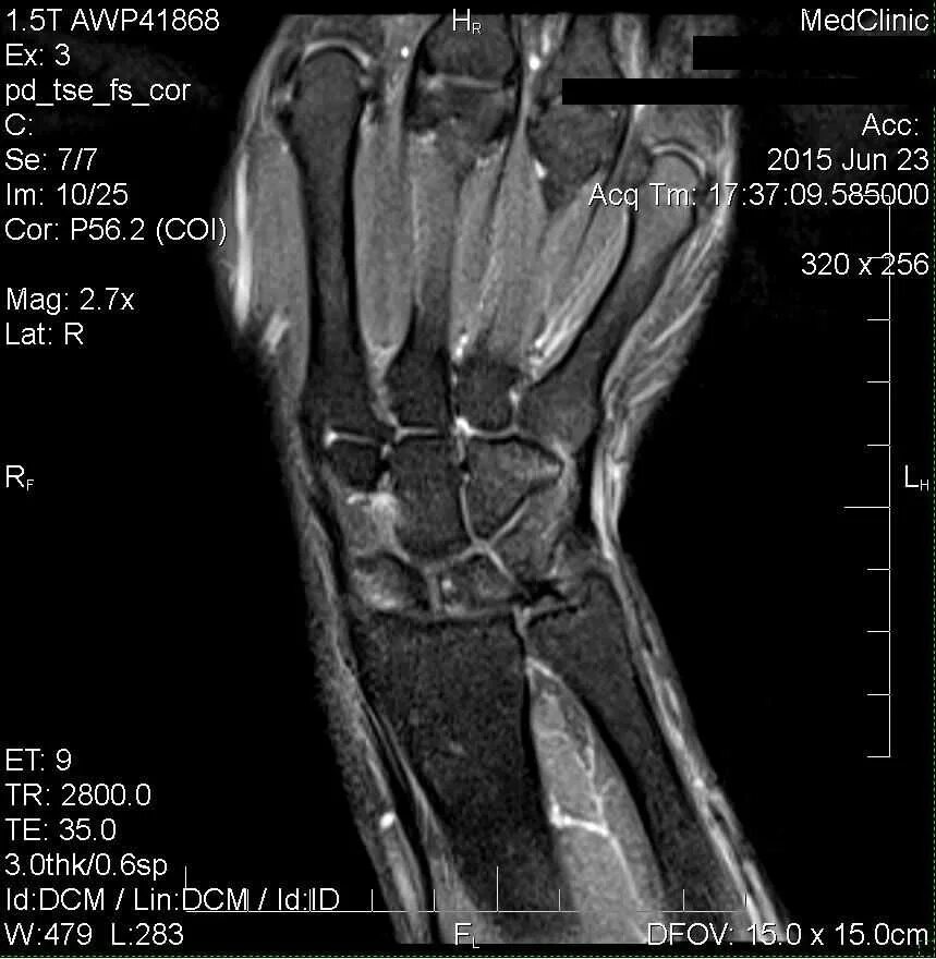 Делают ли мрт руки. TFCC лучезапястного сустава мрт. Лучезапястный сустав мрт аксиальные. Стилоидит лучезапястного сустава на мрт. Мрт лучезапястного сустава норма.