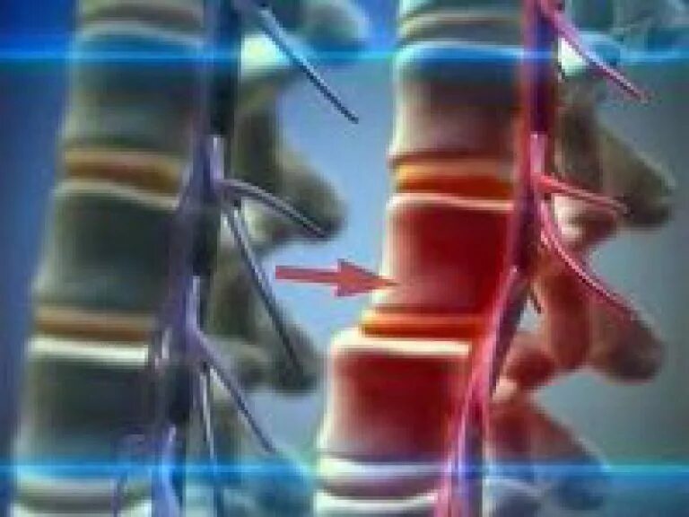 Кровоснабжение межпозвоночных дисков. Ретролистез l5. Листез позвоночника. Смещенный диск позвоночника. Смещение межпозвонковых дисков.