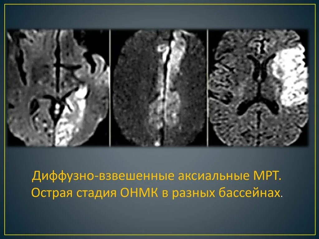 Диффузное мрт. Mrt dwi головной мозг. ишемический инсульт мрт. dwi режим мрт. ишемический инсульт мрт снимок.