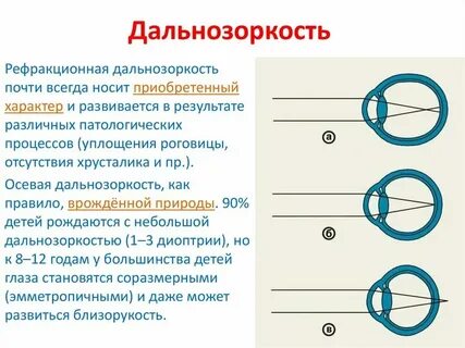 Гиперметропия слабой степени код мкб