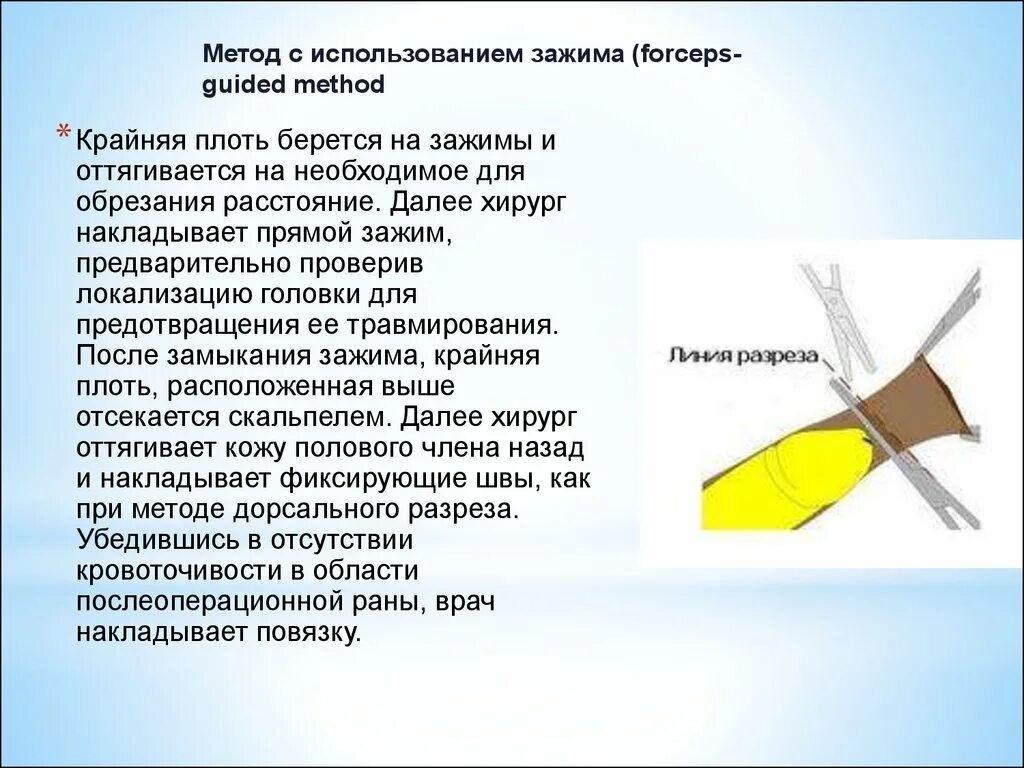 Схема обрезания крайней плоти. Классификация фимоза у детей. Фимоз и парафимоз презентация. Плюсы и минусы обрезания крайней плоти