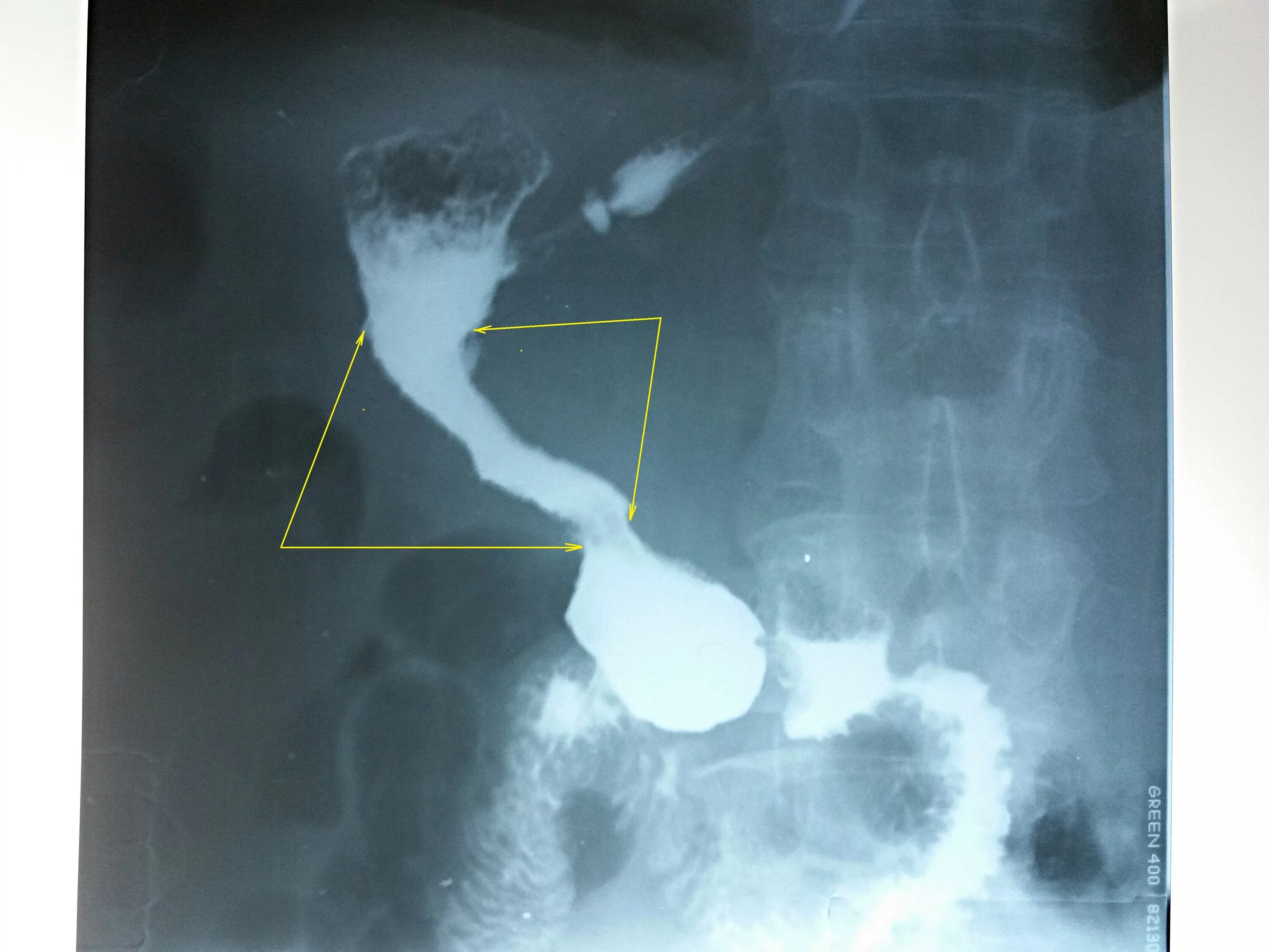 Рентгенологическое исследование желудка с контрастом. Рентгеноскопия пищевода и желудка ДПК. Скопия пищевода желудка
