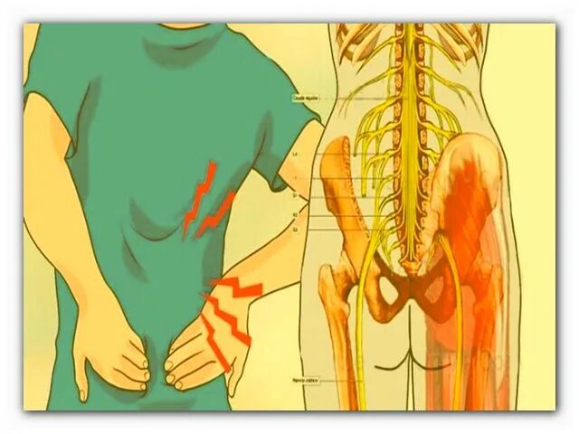 Боли в пояснице нервы. Защемление седалищного нерва. Седалищный нерв в пояснице. Защемление поясничного нерва.