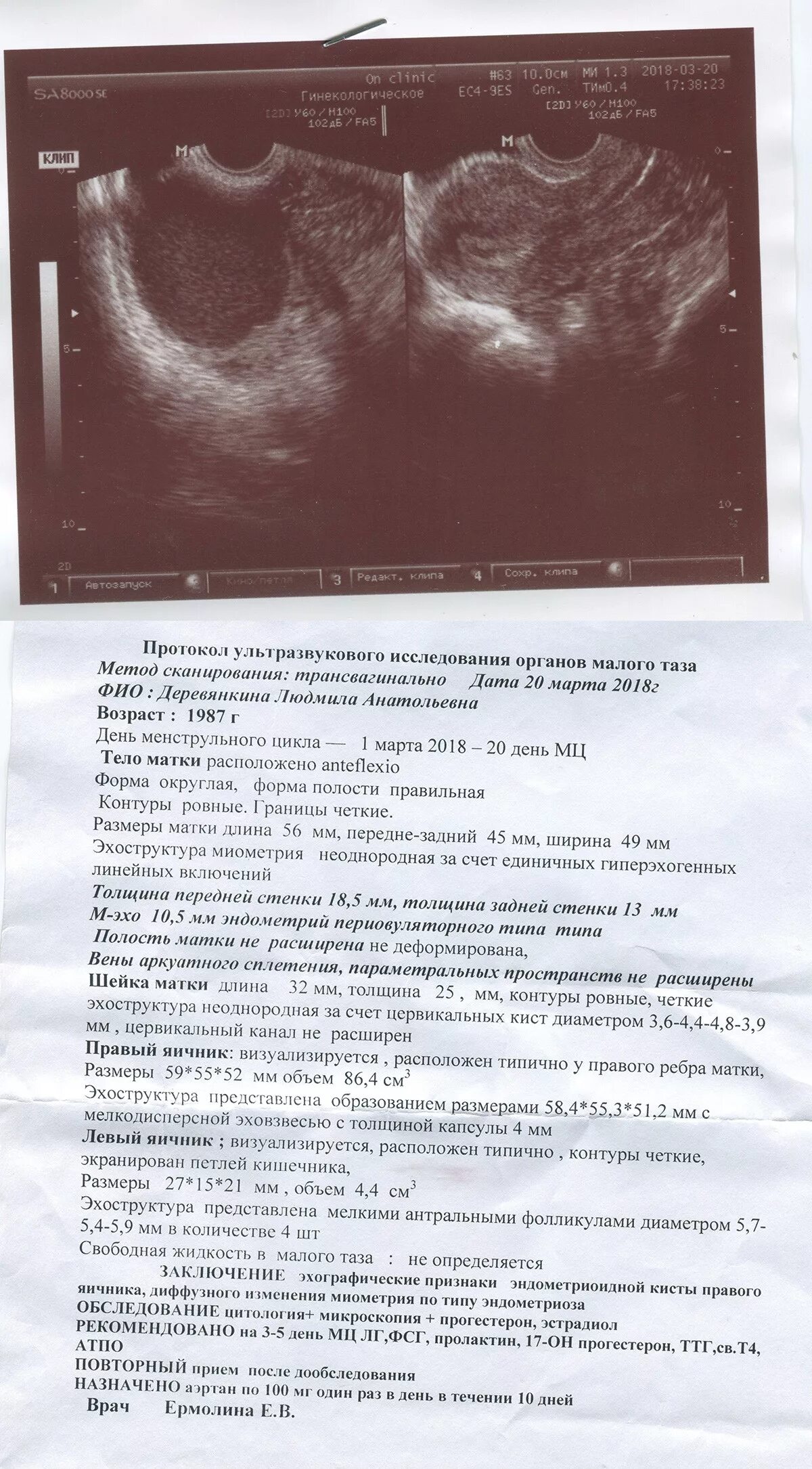 Задержка месячных при кисте яичника