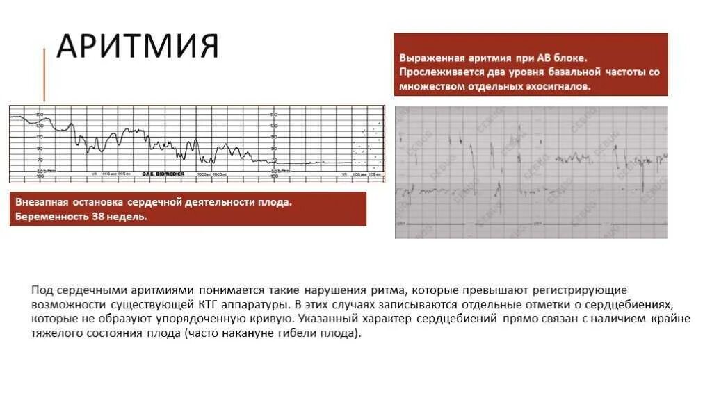 Пульс на ранних сроках. Синусовый ритм КТГ. Нарушение сердечного ритма при беременности. Синусовая аритмия у беременных 2 триместр. Аритмичное сердцебиение у плода.