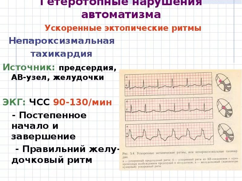 Эктопический ритм сердца на экг. Активные эктопические комплексы и ритмы. Ускоренные эктопические ритмы. Эктопический ритм сердца на экг. Ускоренный эктопический ритм.