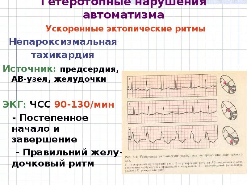 Ускоренный наджелудочковый ритм на ЭКГ. Непароксизмальные тахикардии на ЭКГ. Непароксизмальная Узловая тахикардия ЭКГ. ЭКГ при непароксизмальной тахикардии. Эктопический предсердный ритм что это