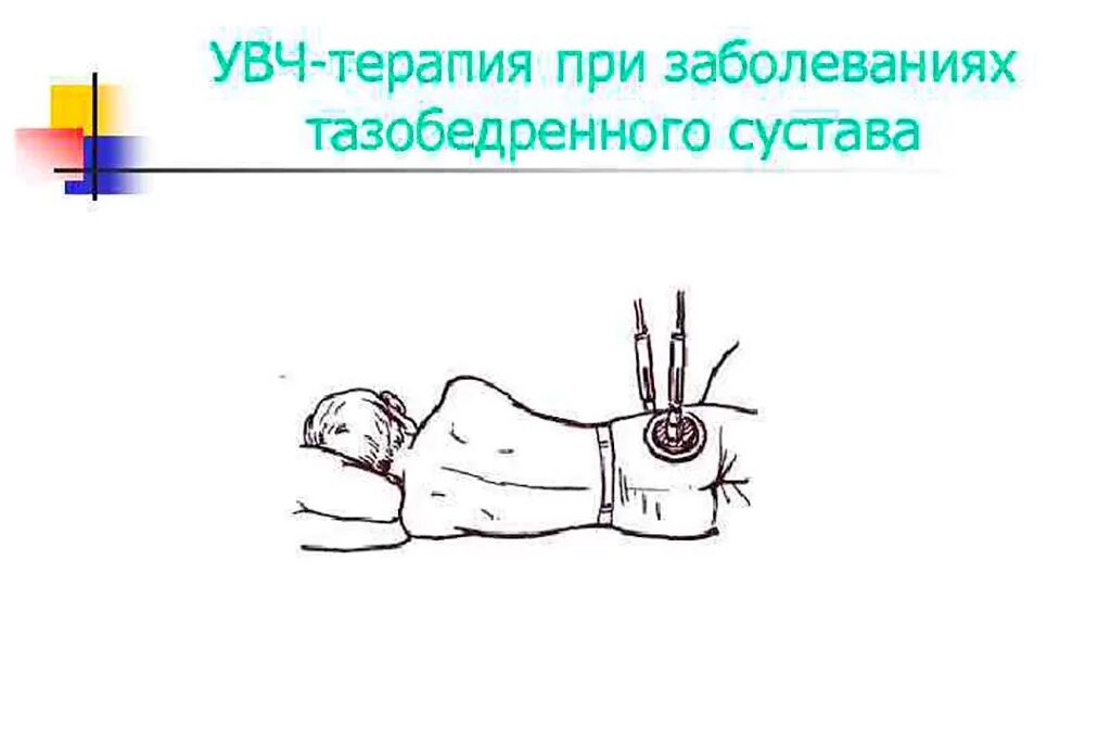 Увч терапия коленного сустава. Увч терапия суставов. Увч терапия коленного сустава. Физиопроцедуры увч. Физиотерапия электрофорез увч.