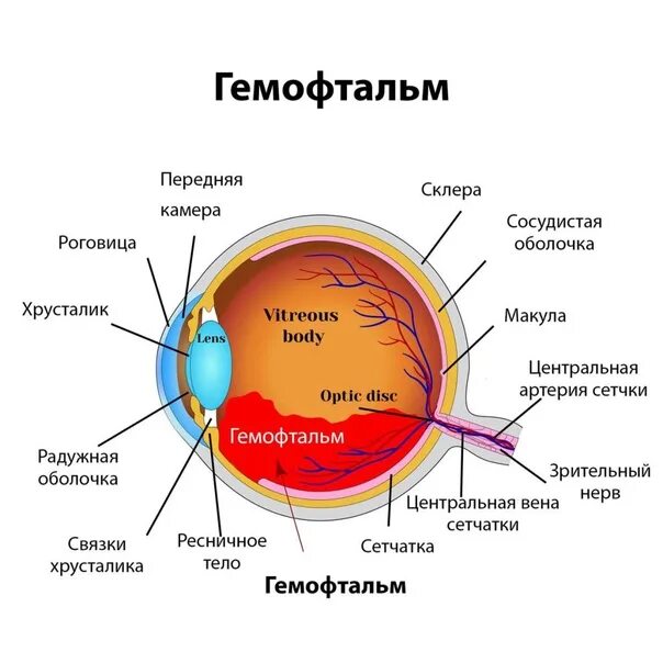 Гемофтальм мкб 10. (Гемофтальм) в оболочку глаза;.