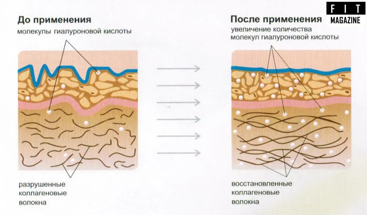 Гиалуроновая кислота где. Воздействие гиалуроновой кислоты на коллагеновые волокна. Коллагеновое волокно схема кожа. Коллаген эластин фибробласты. Гиалуроновая кислота в коже.