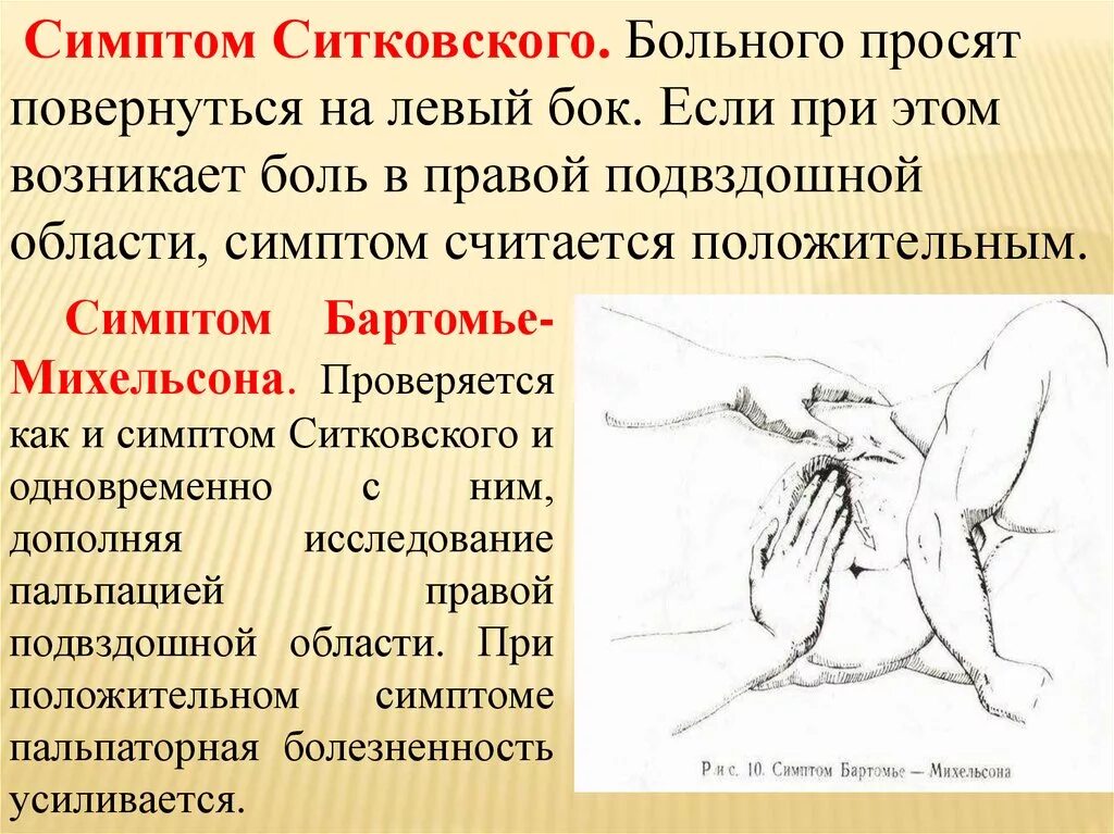 Острый аппендицит осмотр. Симптомы Ровзинга Ситковского Бартомье-Михельсона. Симптом Ситковского острого аппендицита. Симптомы Воскресенского Щеткина-Блюмберга Ровзинга Ситковского. Симптом Ситковского при остром аппендиците.