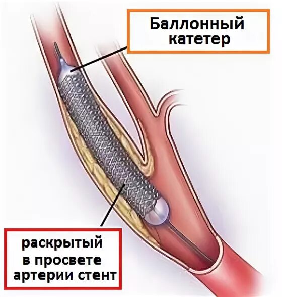 Стентирование код