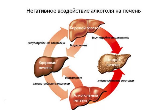 Влияние этанола на печень. Как алкоголь влияет на печень.