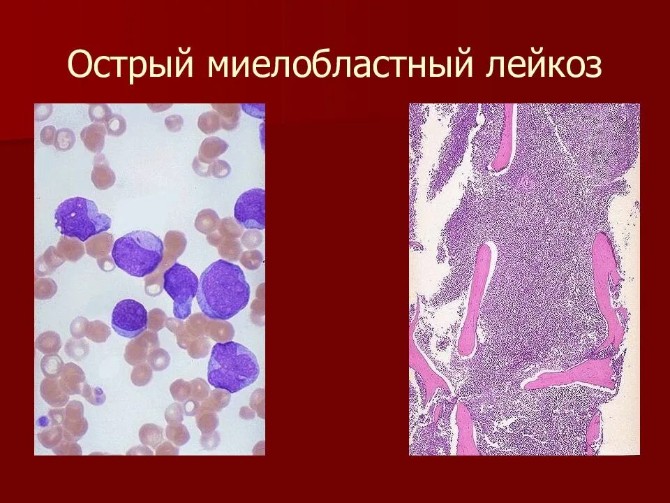 Острый миелоидный лейкоз прогноз. Острый миелолейкоз гистология. Острый миелобластный лейкоз гистология. Острый миелоидный лейкоз картина крови. Острый миелобластный лейкоз картина костного мозга.