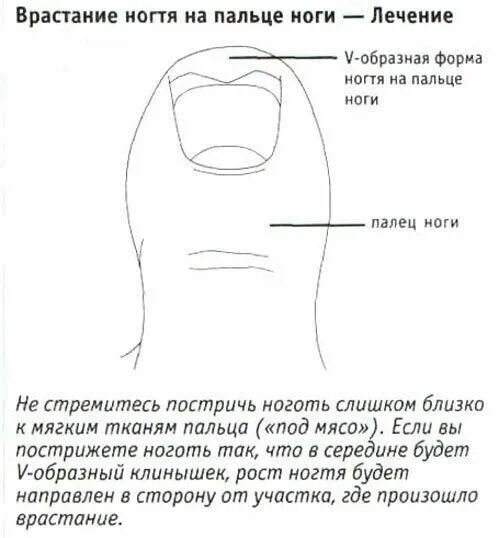 Как правильно стричь вросший ноготь. Как правильно стричь ногти на ногах. подстричь вросший ноготь. как правильно подстригать ногти.