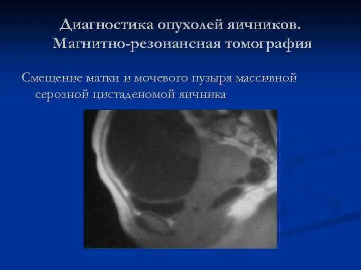 Доброкачественные опухоли яичника рекомендации. Цистаденома яичника классификация. Муцинозная опухоль яичника мрт. Папиллярная серозная цистаденома.