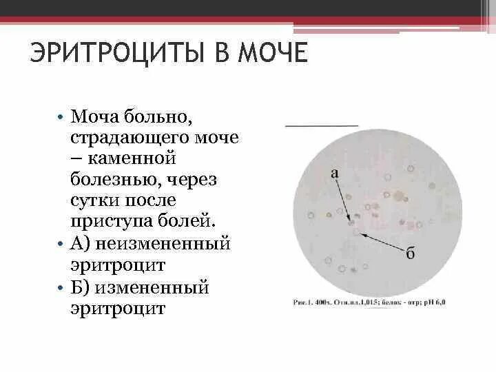 Выщелоченные эритроциты в моче норма. Измененные (дисморфные) эритроциты в моче. Эритроциты в моче измененные и неизмененные норма. Измененные эритроциты в моче. Появление эритроцитов в моче