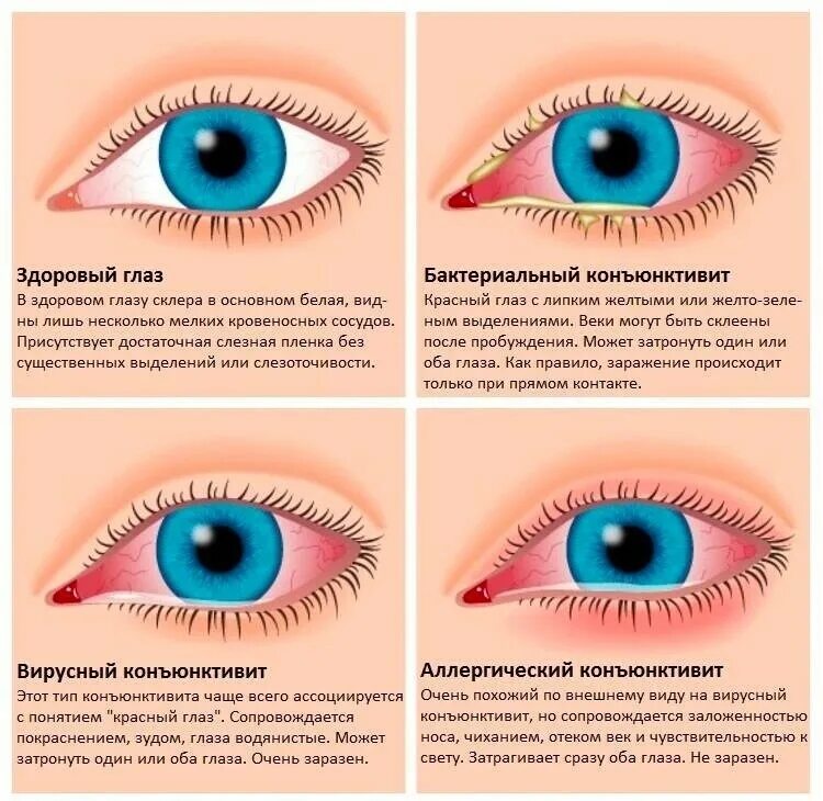 Орви и глаза. Бактериальный конъюнктивит симптомы. Конъюнктивит кератит иридоциклит. Конъюнктивит типы проявления. Вирусный конъюнктивит симптомы.