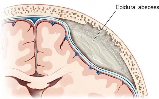 Спинальный эпидуральный абсцесс клиника. Эпидуральный абсцесс головного мозга. Эпидуральный абсцесс головного мозга мрт. Воспаление головного мозга латынь