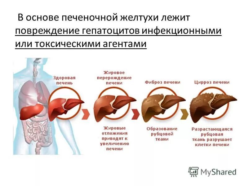 Диффузные изменения печени паренхимы печени. Цирроз печени лабораторные исследования. Диффузные изменения печени паренхимы печени. Диффузные изменения паренхимы печени. Диффузные изменения печени по типу жировой инфильтрации.
