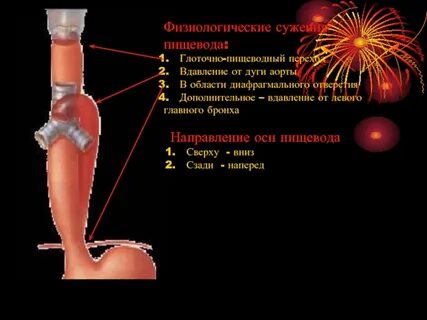 Суженное место
