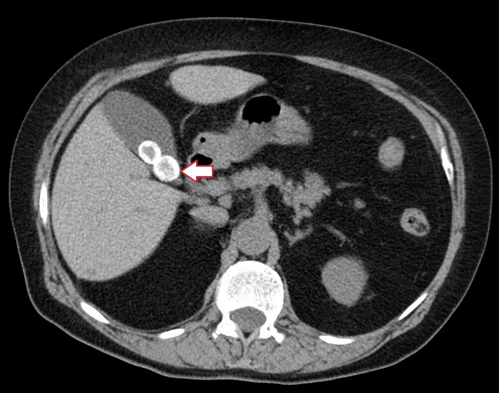 Камни на кт видны. Конкременты желчного пузыря на кт. Желчекаменная болезнь кт. Кт при желчнокаменной болезни. Желчнокаменная болезнь кт.