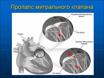 Пролапс передней стенки