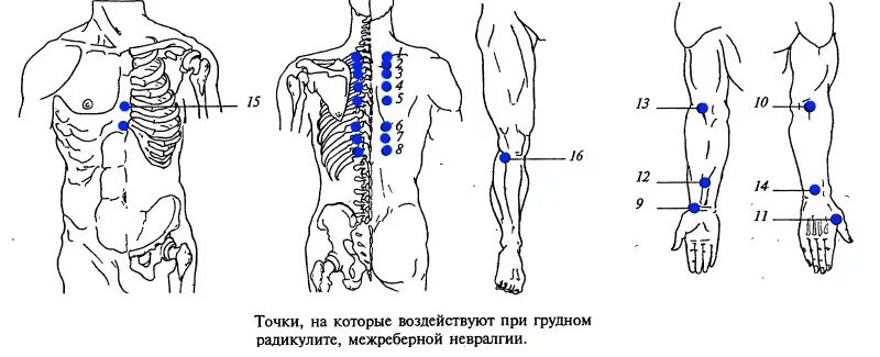 Можно ли при межреберной невралгии делать массаж. Точечный массаж при межреберной невралгии точки. точечный массаж при межреберной невралгии. массаж при межреберной невралгии схема. точки массажа при межреберной невралгии.