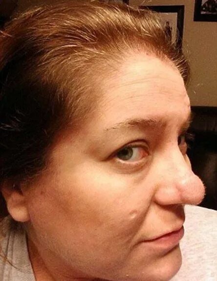 Teen's head ballooned 'like a light bulb' after allergic reaction to hair dye - 