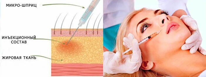 Мезо уровень. Схема мезотерапии лица. Мезотерапия лица схема. Техника мезотерапии лица.