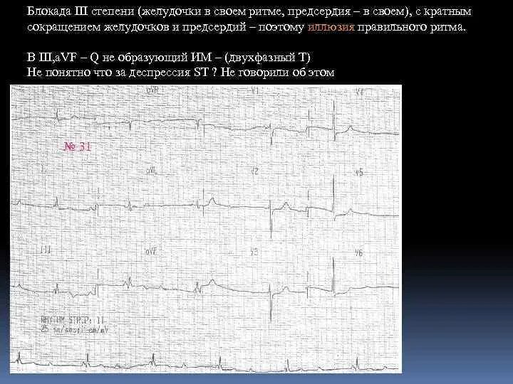 Синоатриальная блокада 3 степени на ЭКГ. Синоаурикулярная блокада 3 степени. Предсердия и желудочки сокращаются в своём ритме. Синус арест и синоатриальная блокада 3 степени. Са блокада степени