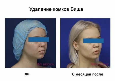 Функция комка биша