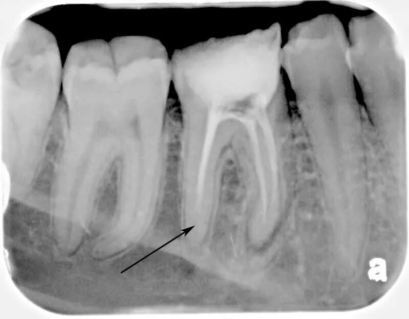 Дергает зуб под коронкой. Почему болит зуб без нерва при нажатии. Воспаление нерва зуба на рентгене. Почему болит зуб без нерва при нажатии. Перфорация корневого канала рентген.