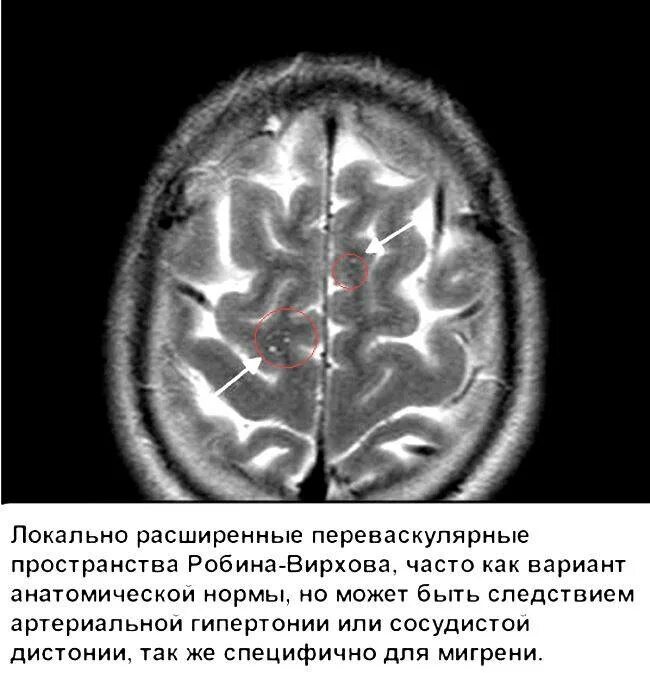 Расширено периваскулярное пространство головного мозга. Расширение пространства вирхова робина на мрт. периваскулярные пространства вирхова-робина мрт головного мозга. расширение периваскулярных пространств вирхова-робина мрт. пространства робина вирхова на кт.
