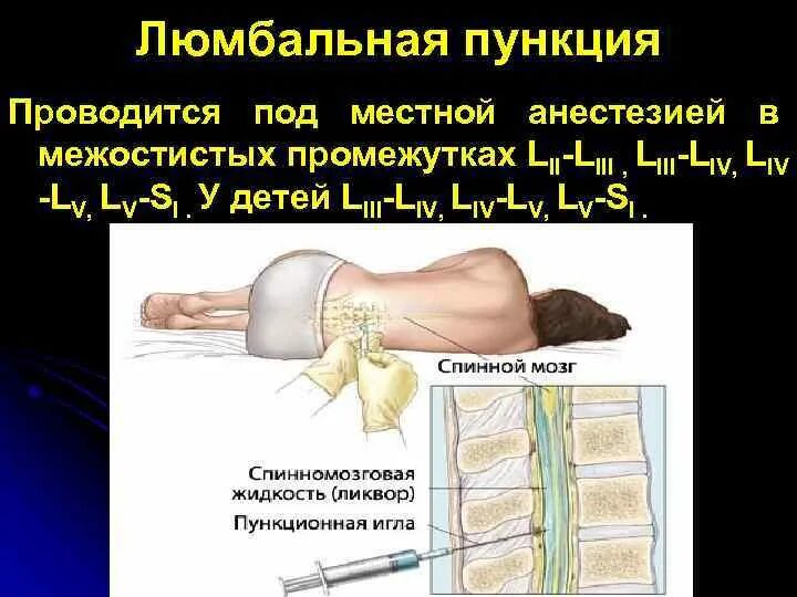 Люмбальная пункция алгоритм. Люмбальная спинномозговая пункция топографическая анатомия. Люмбальная пункция показания техника у детей. Люмбальная пункция уровень проведения. Люмбальная пункция осложнения у детей.