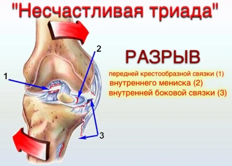 Что значит связки. Разрыв связок ПКС коленного сустава. Механизм травмы передней крестообразной связки коленного сустава. Разрыв связок ПКС коленного сустава коленный сустав. Разрыв связок передней крестообразной связки коленного сустава.