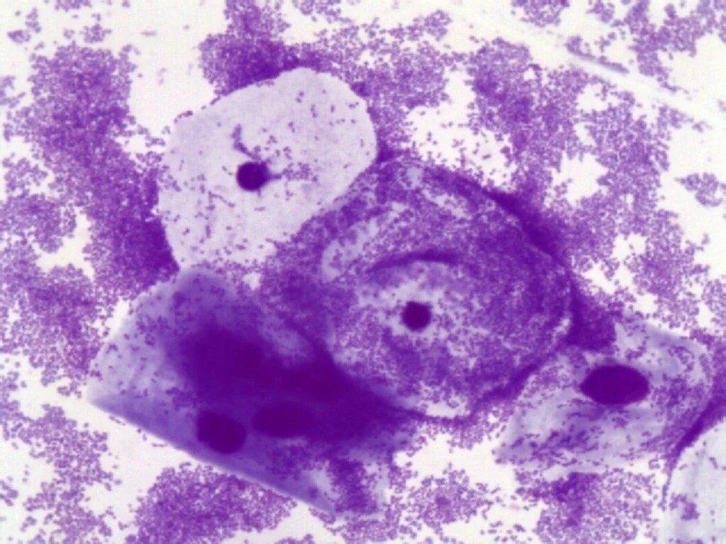 Гарднерелла и мобилункус. Ключевые клетки в мазке у женщин что. Бактериальный вагиноз мазок. Ключевые клетки при бактериальном вагинозе. Ключевые клетки в мазке под микроскопом.
