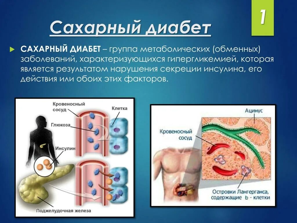 Как вылечить сахарный диабет 2го. Сахарный диабет. что такое сохрани диабет. тему сахарный диабет. сахарный диабет картинки.