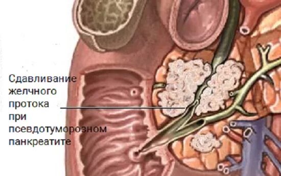 Анатомия сфинктера Одди. Обтурация протоков поджелудочной железы. Стентирование вирсунгова протока поджелудочной железы. Поджелудочная железа камни операция