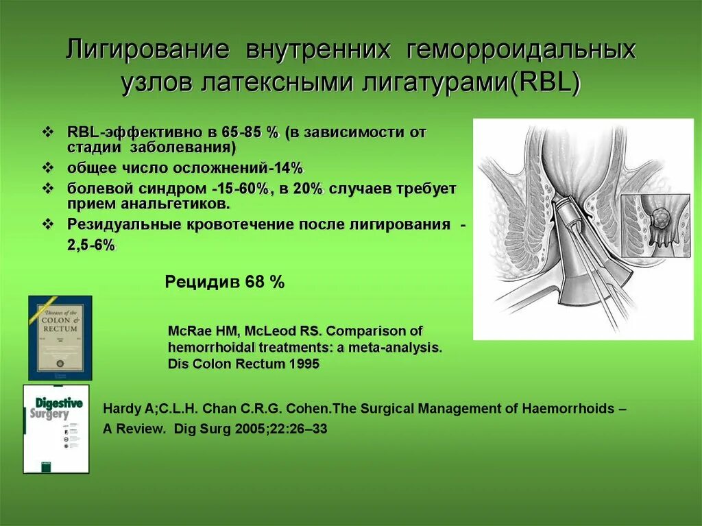 Лигирование внутренних геморроидальных узлов. Легирование латексное лигирование геморроидальных узлов. Внутренние геморроидальные узлы. Рекомендации после лигирования геморроидальных узлов.