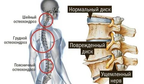 Остеохондроз что делать форум